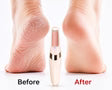 Electric Foot File Grinder | Dead Skin & Callus Remover Pedicure Tool